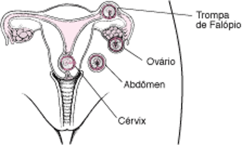 Gravidez ectópica: Uma gravidez fora do útero