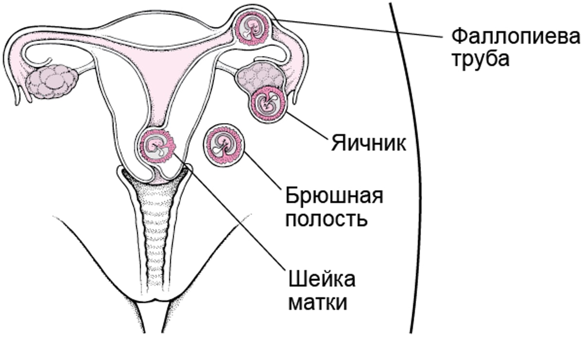 Внематочная беременность: смещенная беременность
