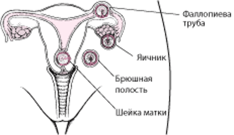 Внематочная беременность: смещенная беременность