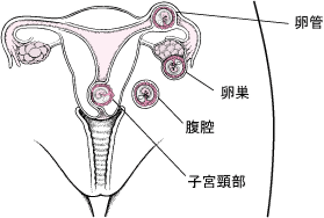異所性妊娠：異常な場所での妊娠