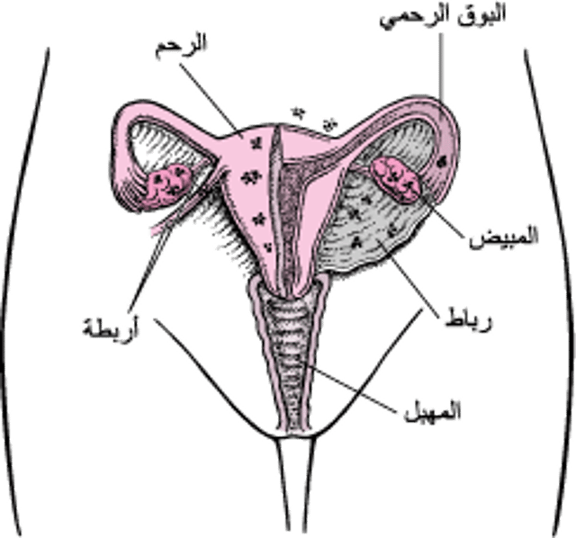 الانتِباذُ البِطَانِيُّ الرَّحِمِيّ: نَسيج في غير موضعه، نَسيج مُنزَاح