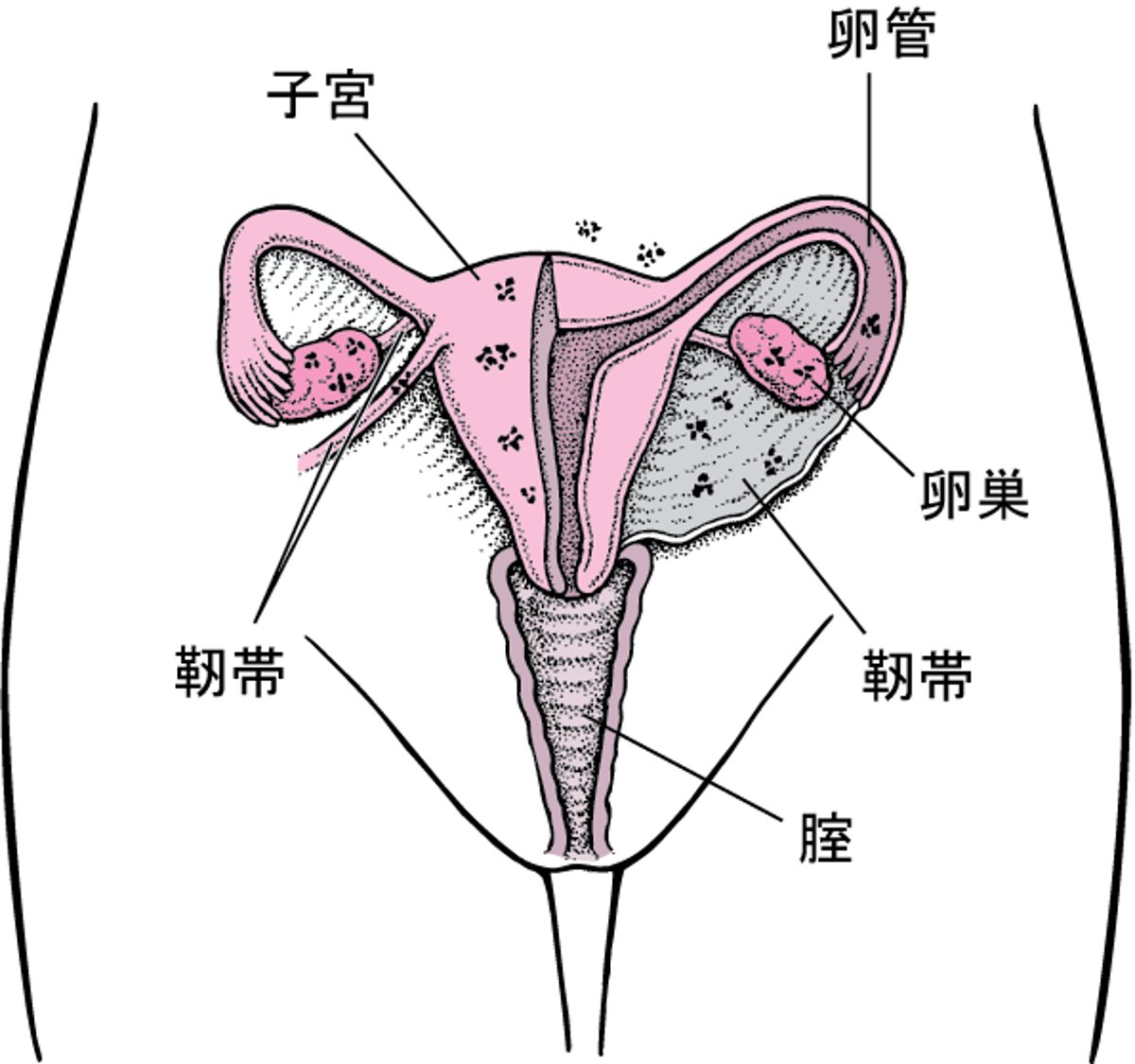 子宮内膜症：異常な場所にできた組織