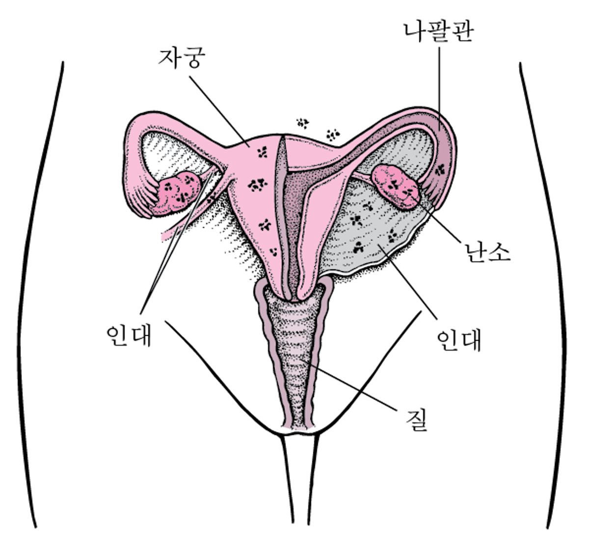 자궁내막증: 잘못된 조직