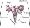 Endometriose: Tecido ectópico