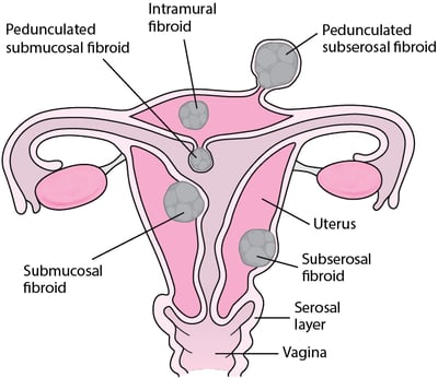 Where Uterine Fibroids Grow
