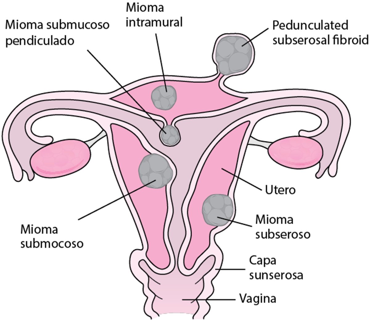 Dónde crecen los miomas (fibromas) uterinos