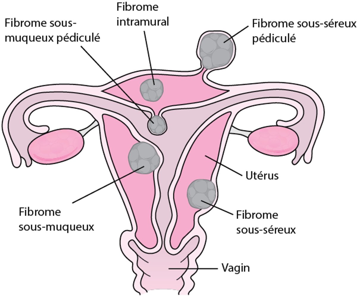 Où se développent les fibromes utérins