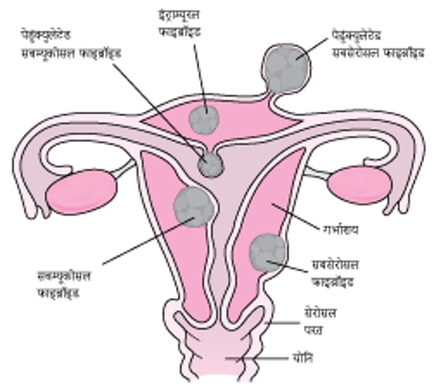 जहाँ गर्भाशय के फाइब्रॉइड बढ़ते हैं