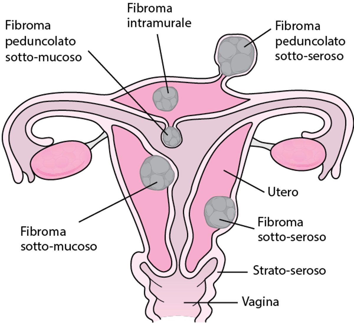 Dove crescono i fibromi uterini
