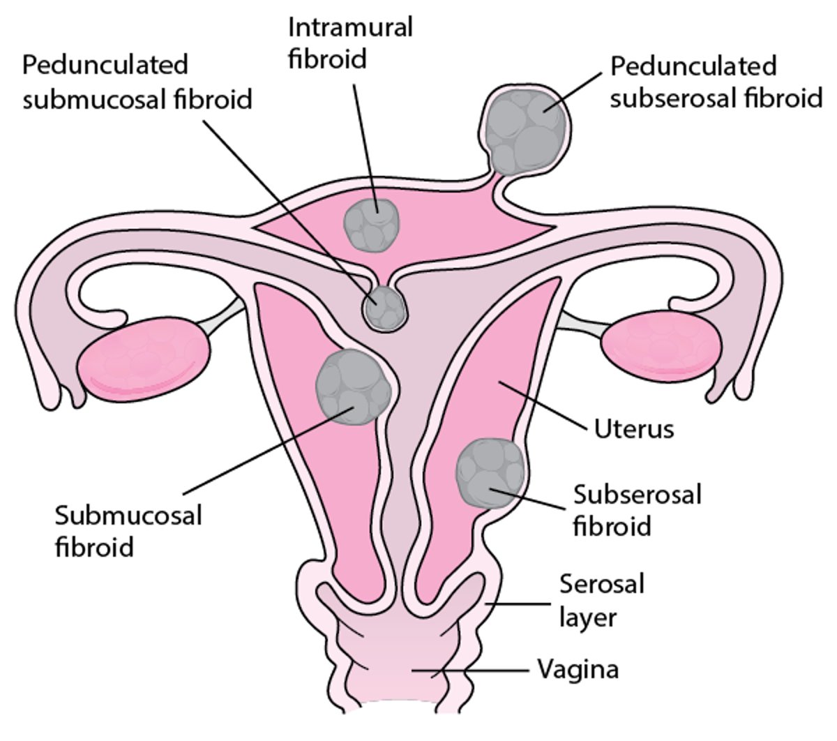 자궁 섬유종 성장 위치