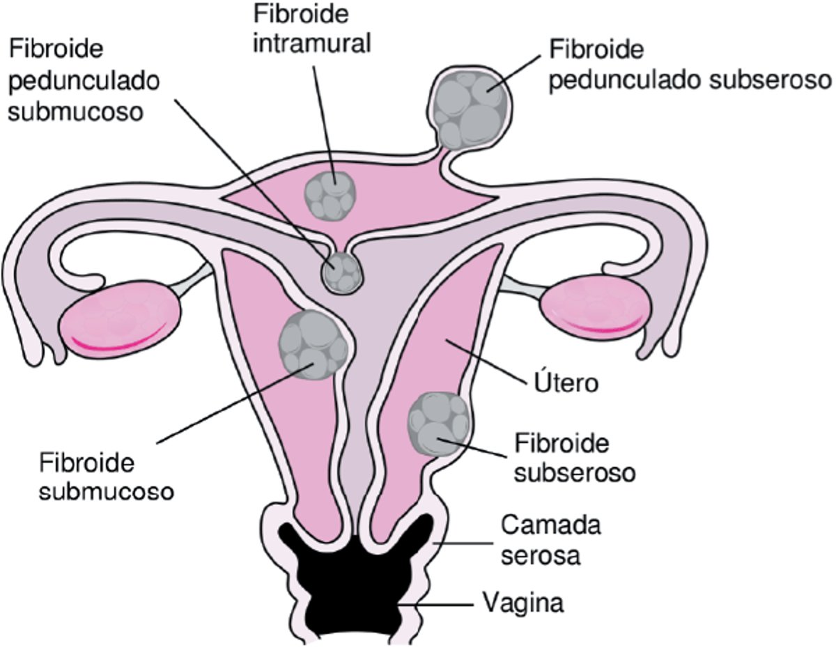 Locais onde crescem os miomas uterinos