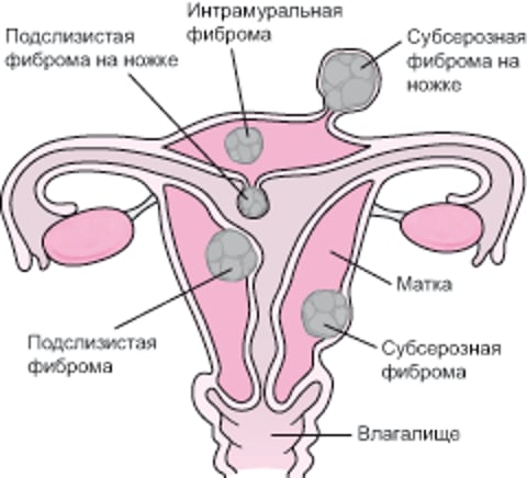 Где растут фибромы матки