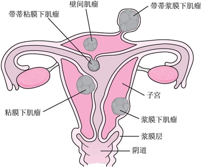 子宫肌瘤生长部位