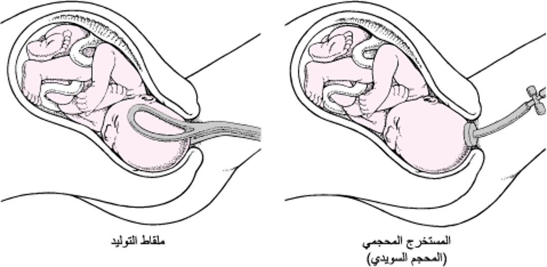 استعمال الملاقط أو المُستَخرِج بالتخلية