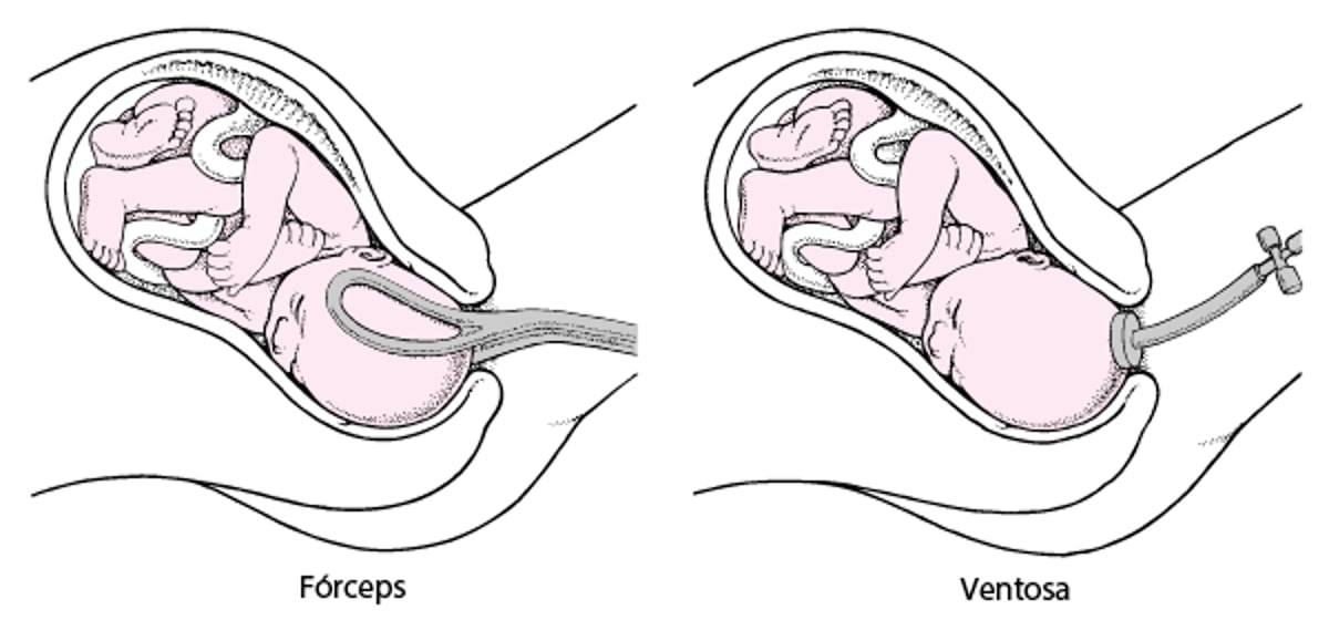 Utilización de fórceps o ventosa