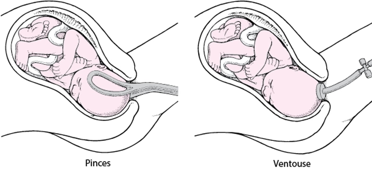 Utilisation d’un forceps ou de la ventouse obstétricale
