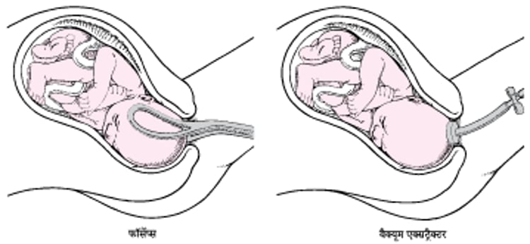 चिमटे या एक वैक्यूम एक्सट्रैक्टर का उपयोग करना