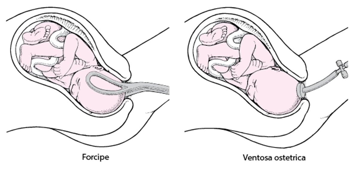 Uso del forcipe o della ventosa ostetrica