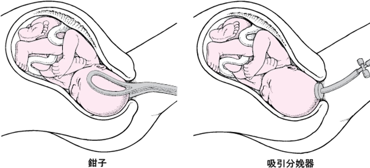 鉗子や吸引器の使用