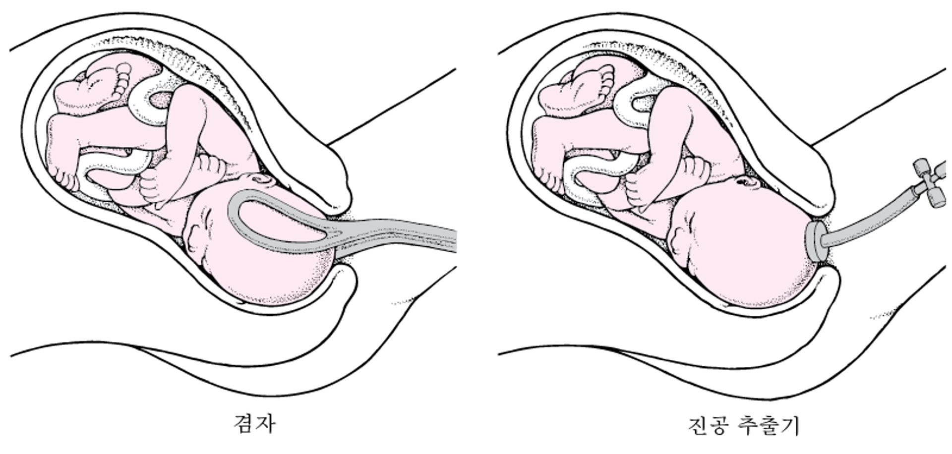 겸자 또는 진공 흡착기 사용