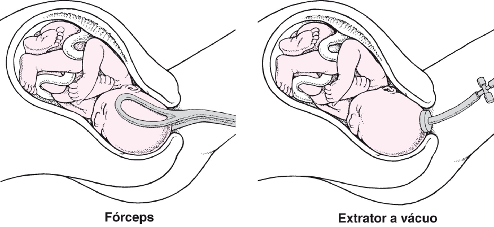 Usando um fórceps ou extrator a vácuo