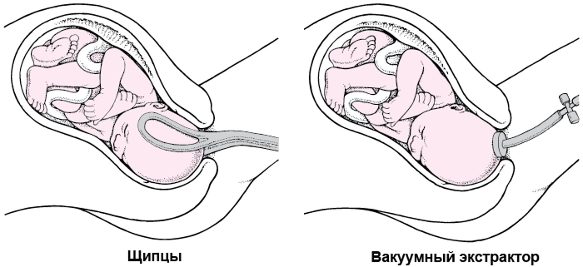 Использование вакуумного экстрактора или щипцов