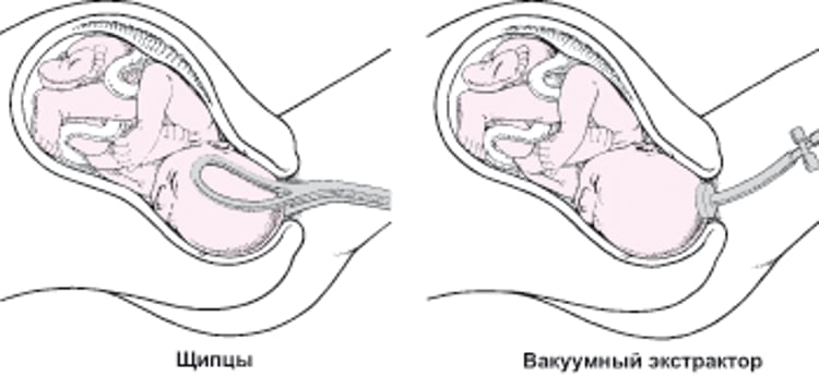 Использование вакуумного экстрактора или щипцов
