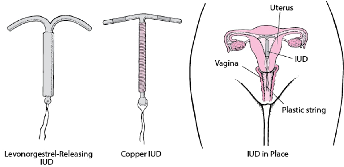 Understanding Intrauterine Devices
