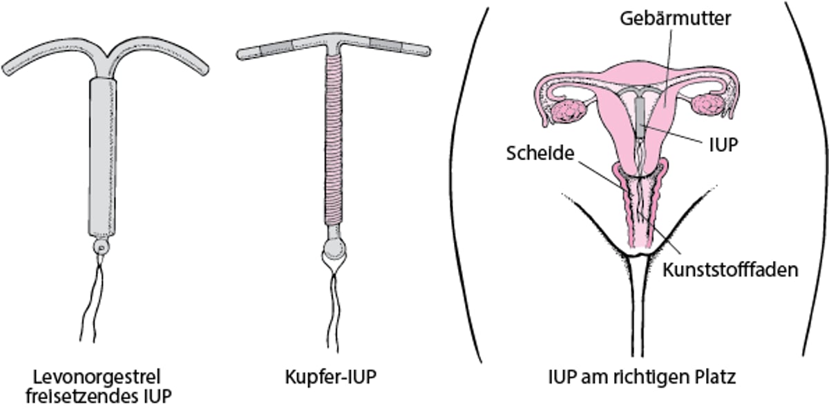 Umgang mit Intrauterinpessaren