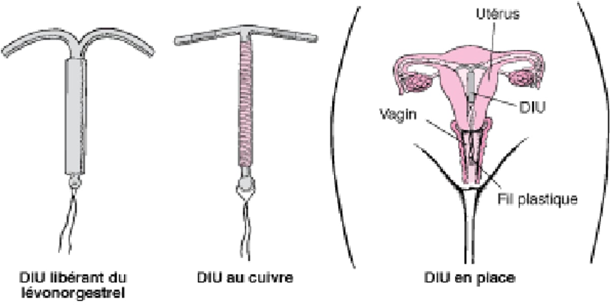 Comprendre les dispositifs intra-utérins (stérilets)