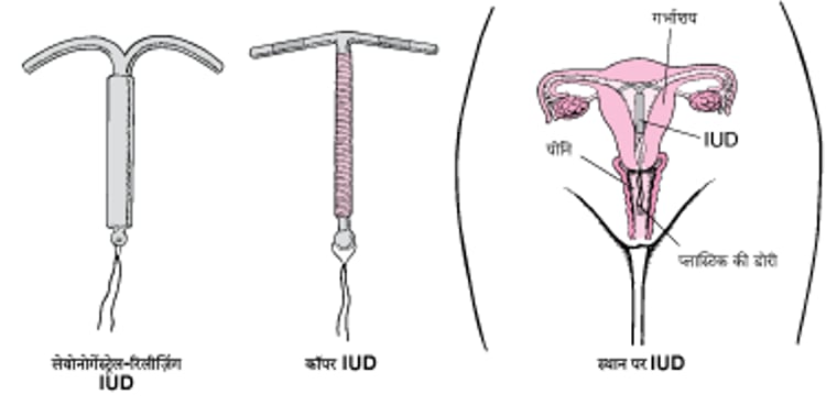 अंतर्गर्भाशयी उपकरणों को समझना