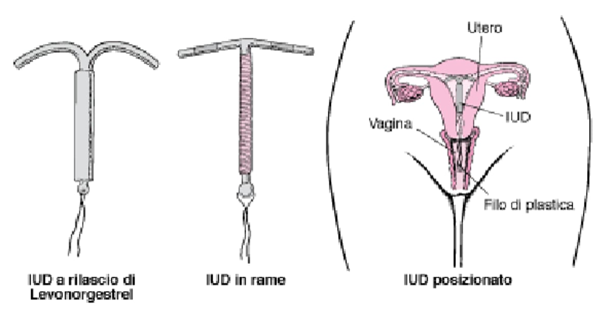 Informazioni sugli IUD