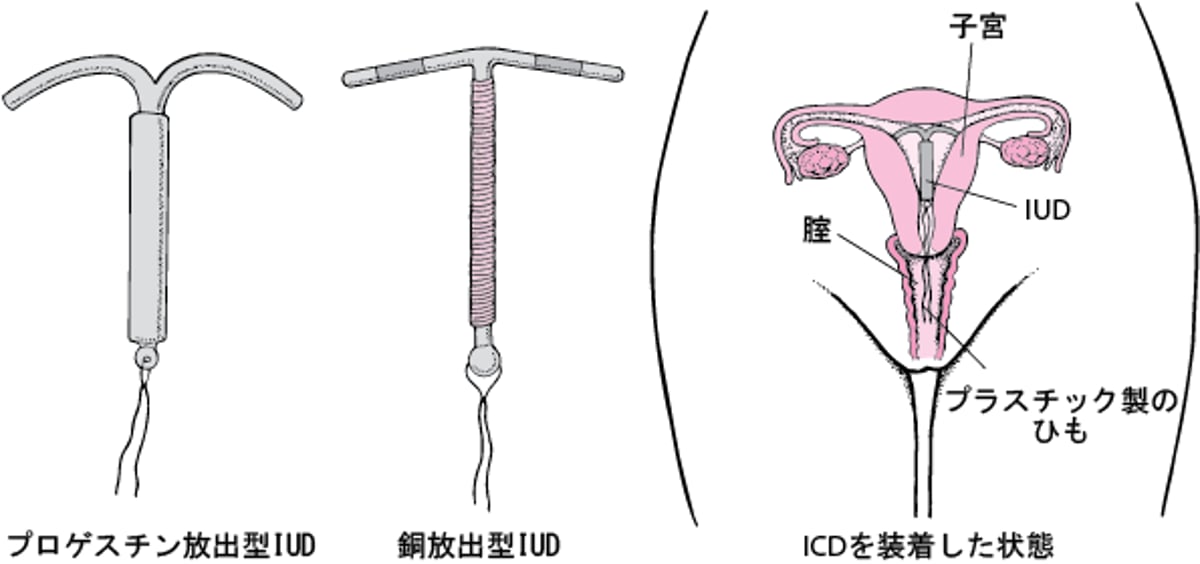<ruby >子宮内避妊器具<rt >しきゅうないひにんきぐ</rt></ruby>を<ruby >理解<rt >りかい</rt></ruby>する