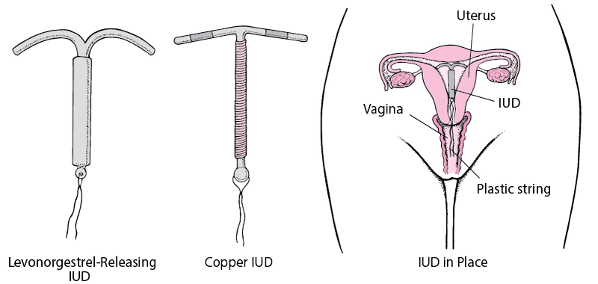 자궁내 피임 장치의 이해