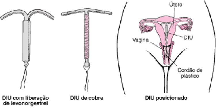 Entendendo os dispositivos intrauterinos