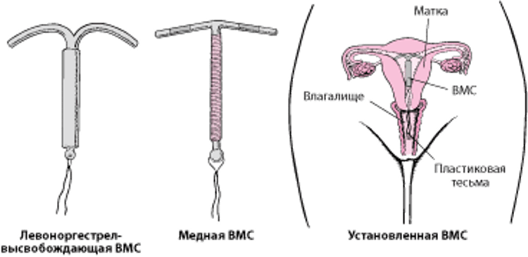 Что представляют собой внутриматочные спирали