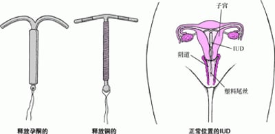 了解宫内节育器