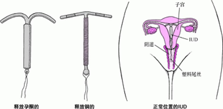 了解宫内节育器