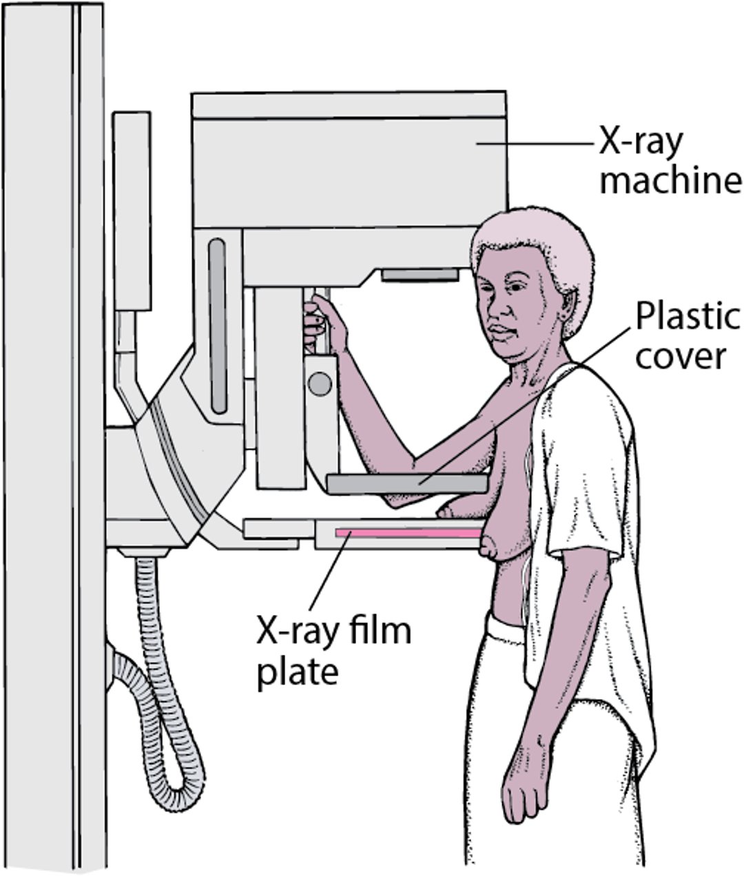 Mammography: Screening for Breast Cancer
