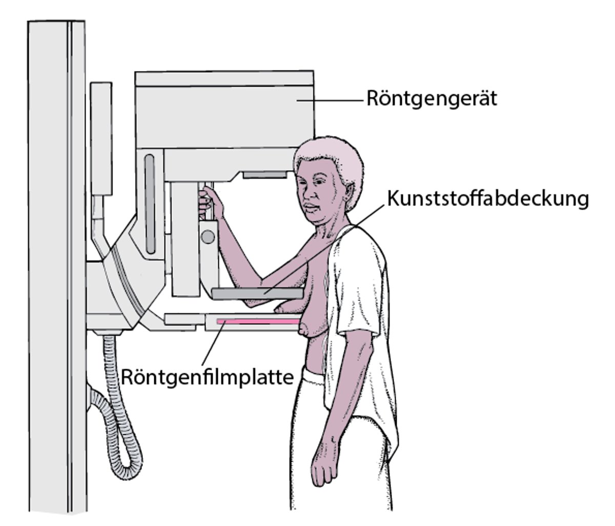 Mammografie: Früherkennung von Brustkrebs