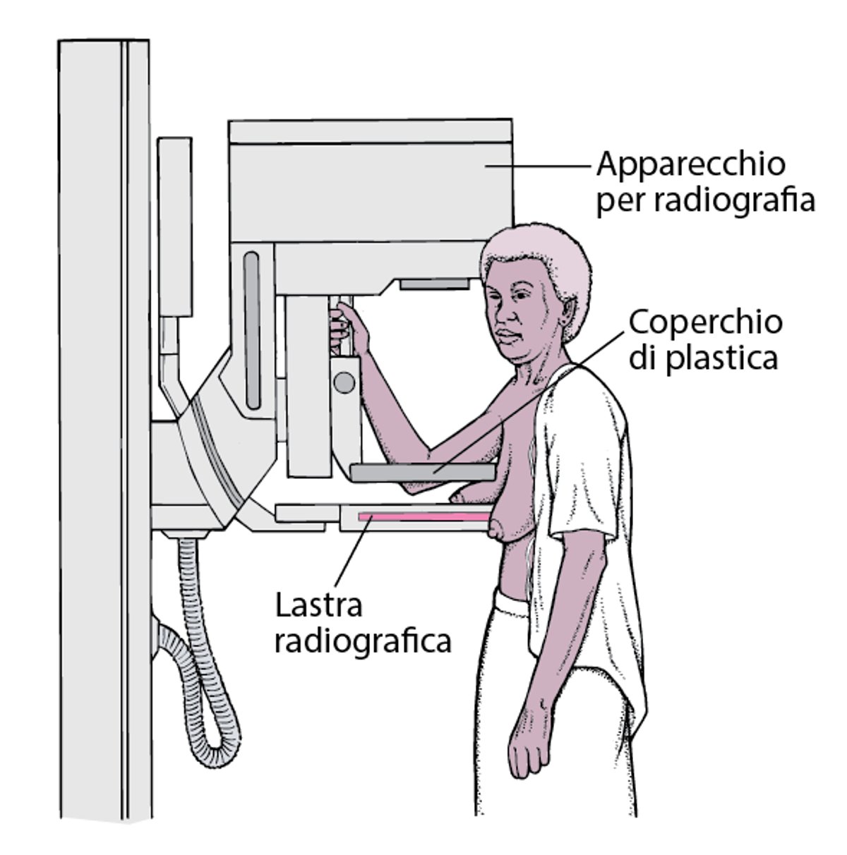 Mammografia: screening per il cancro della mammella