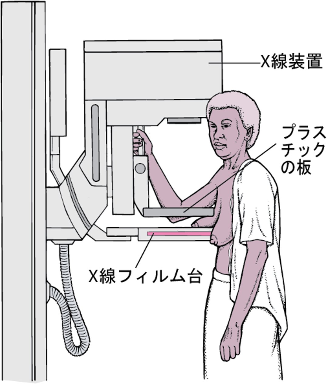 マンモグラフィー：乳がんのスクリーニング