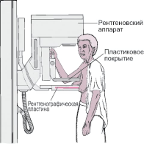 Маммография: Скрининг на рак молочной железы