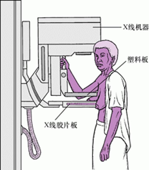 乳房 X 线摄影：乳腺癌筛查