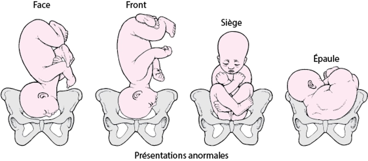 Position et présentation du fœtus