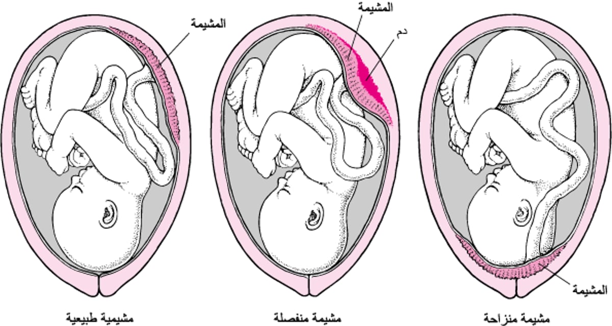 مشاكل مع المشيمة