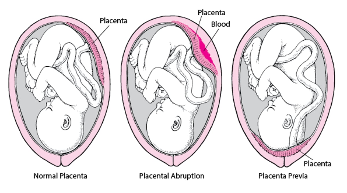 Probleme mit der Plazenta