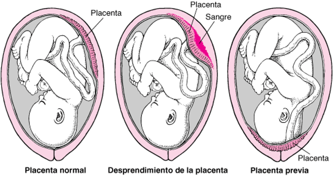 Problemas con la placenta