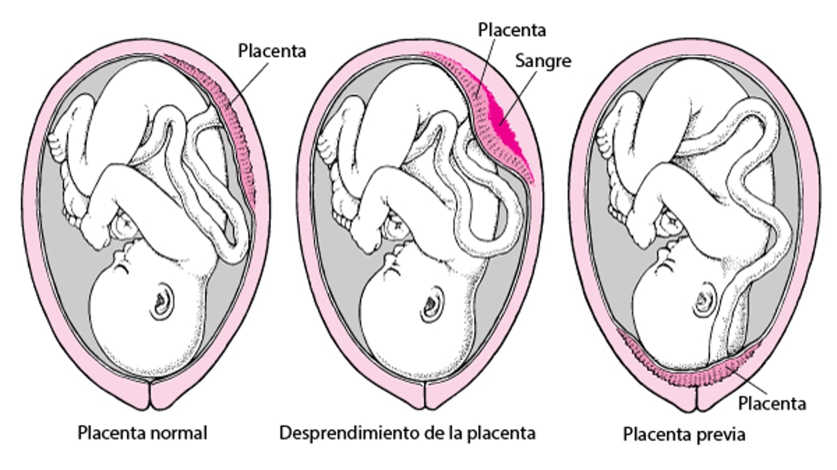 Problemas con la placenta