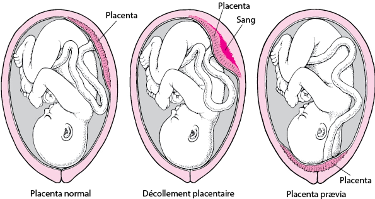Troubles placentaires